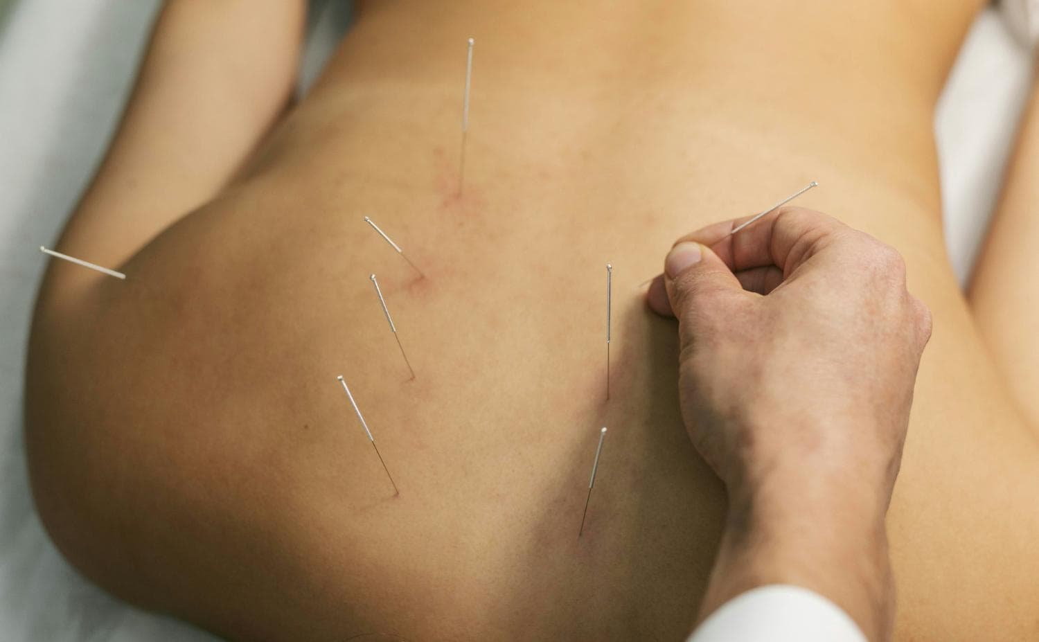 Dry Needling for Hip Pain